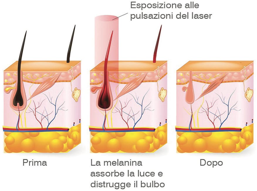 Funzionamento macchinario laser diodo